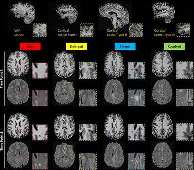 Evolution of Cortical and White Matter Lesion Load in Early-Stage Multiple Sclerosis: Correlation With Neuroaxonal Damage and Clinical Changes